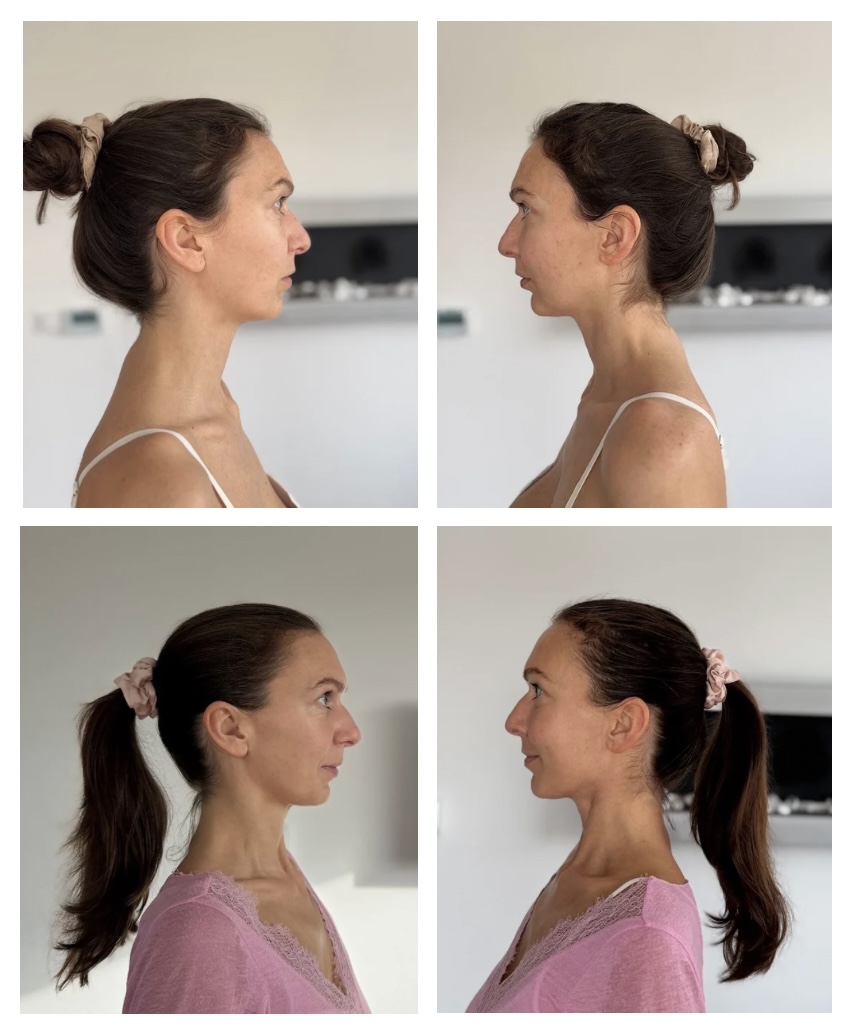 Pred - 2.4.2025 - po - 9.11.2025 - MUDr. Veronika Babic - Funkčný anti-aging a modelácia tváre