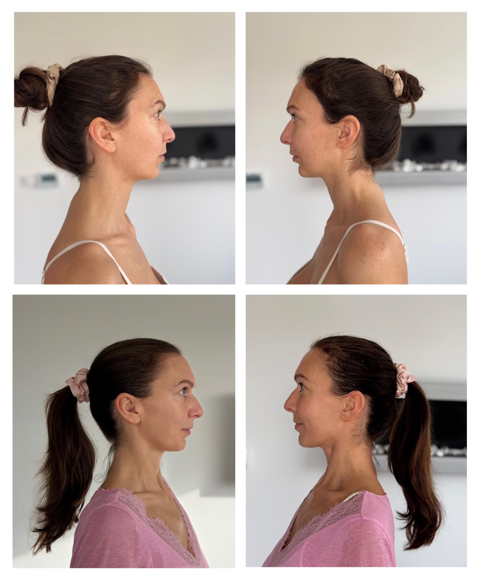 Pred - 2.4.2025 - po - 9.11.2025 - MUDr. Veronika Babic - Funkčné omladenie a modelácia tváre - profilové fotografie