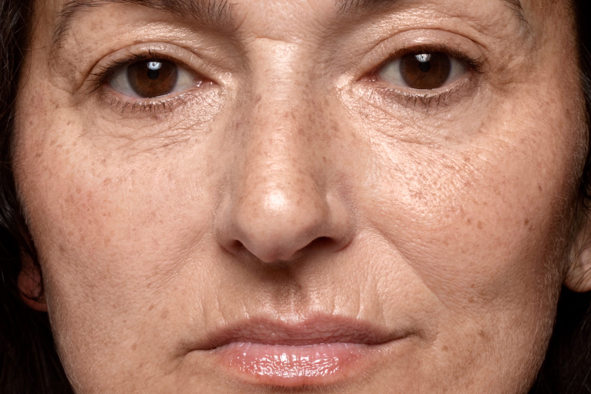 Slnko a starnutie kože: prečo SPF nestačí a čo skutočne rozhoduje o biologickom omladení, pigmentácie, hyperpigmentácia